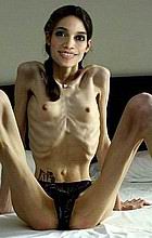 anorexic10.jpg