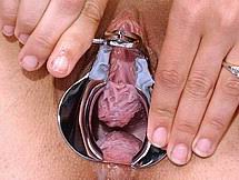 speculum16.jpg
