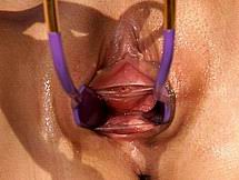 speculum57.jpg